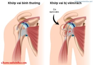Viêm quanh khớp vai
