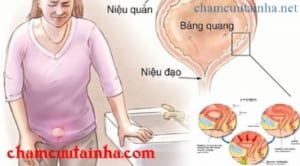 Điều trị bí đái cơ năng bằng điện mãng châm