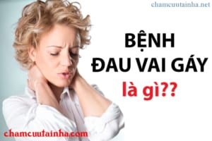Điều trị đau vai gáy châm cứu, Bấm huyệt,Phục hồi chức năng tại nhà