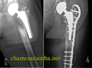 Phục hồi chức năng gãy thân xương đùi