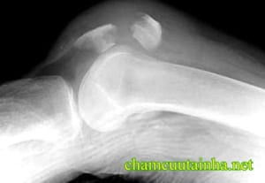 Phục hồi chức năng vỡ xương bánh chè