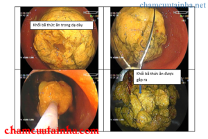 Uống tinh bột nghệ không đúng cách gây tắc ruột