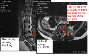 MRI thoát vị đĩa đệm