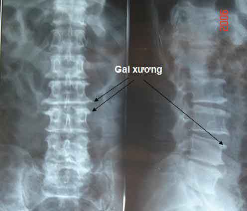 Gai đốt sống thắt lưng