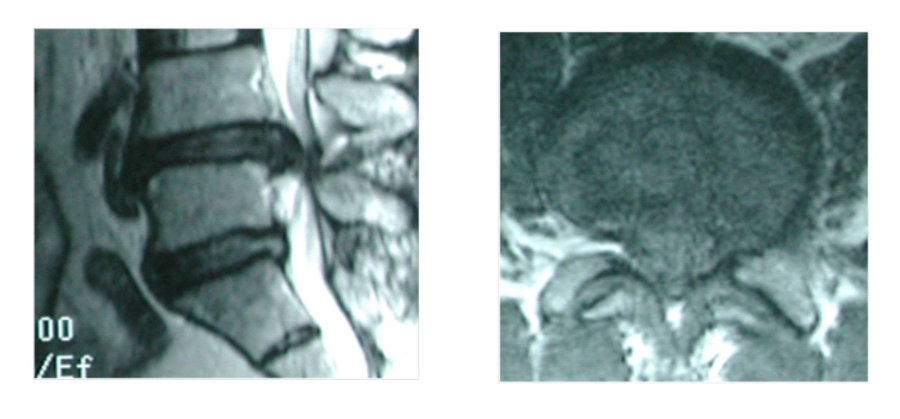 MRI Thoát vị đĩa đệm cột sống thắt lưng