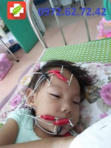 Châm cứu tại nhà điều trị liệt mặt