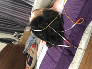 Châm cứu điều trị đau đầu
