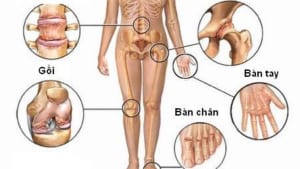 Biểu hiện viêm khớp dạng thấp