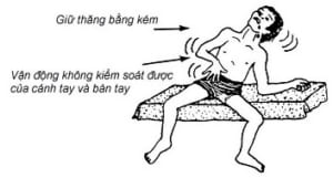 Dấu hiệu trẻ Bại não