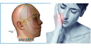 Đau dây thần kinh số V