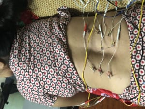 Châm cứu điều trị đau thắt lưng
