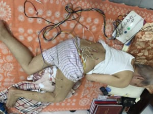 Châm cứu tại nhà điều trị đau thần kinh tọa