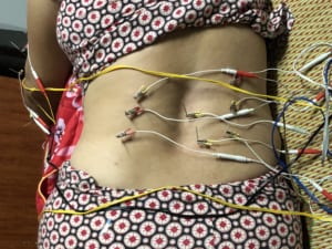 Châm cứu điều trị đau thắt lưng