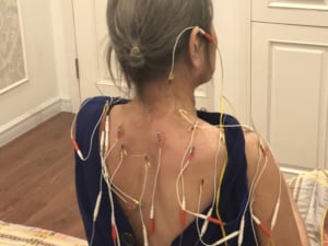 Châm cứu tại nhà điều trị hội chứng cổ vai tay