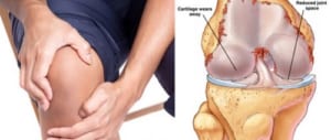 Thoái hóa khớp gối