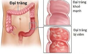 viêm đại tràng mãn tính