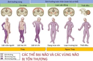 Các thể bại não