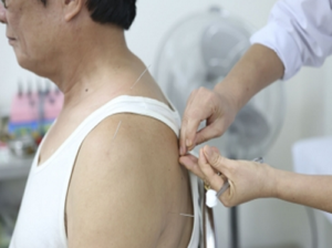 Châm cứu tại nhà