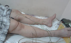 Điều trị Tăng huyết áp bằng châm cứu