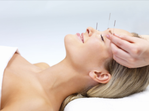 Chữa suy nhược thần kinh bằng châm cứu