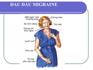 Đau đầu MIGRAINE