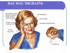Đau đầu MIGRAINE