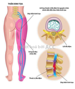 Đau dây thần kinh tọa