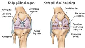 Thoái hóa khớp gối