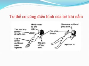 Thể co cứng điển hình