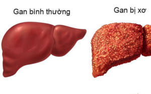 Hình ảnh viêm gan mạn tính