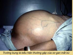 Xơ gan mất bù
