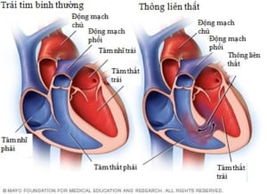 Thông liên thất