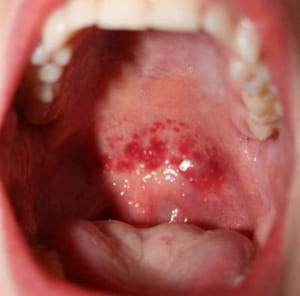 Thấp tim nguyên nhân do viêm họng