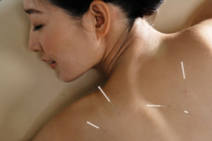 Châm cứu điều trị viêm quanh khớp vai