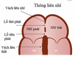 Thông liên nhĩ