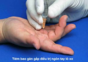 Điều trị ngón tay lò xo