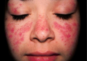 Lupus ban đỏ