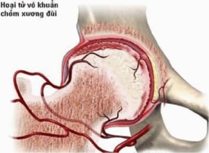 Hoại tử vô khuẩn chỏm xương đùi