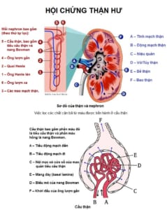 Hội chứng thận hư