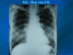 Hình ảnh Xquang hẹp van hai lá
