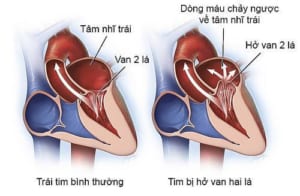 Hình ảnh hở van hai lá
