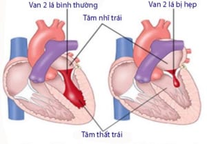 Hình ảnh hẹp van hai lá