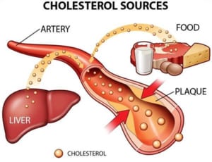 Rối loạn chuyển hóa lipid