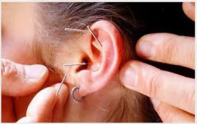 châm cứu điều trị ù tai