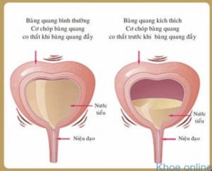 Viêm bàng quang cấp