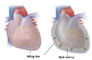 Viêm màng ngoài tim
