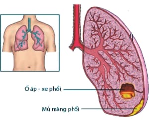 Tràn mủ màng phổi