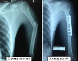 Gãy thân xương cánh tay
