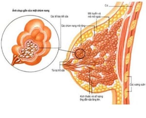 Viêm tắc tia sữa, viêm tuyến vú