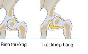 Trật khớp háng